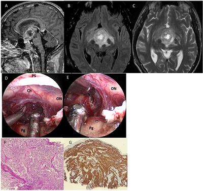 The “chameleon” sellar lesions: a case report of unexpected sellar lesions